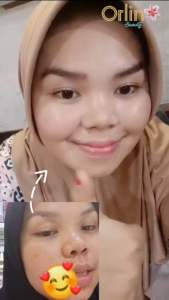 Paket Flek Platinum & Krim BPOM: Solusi Flek dan Noda