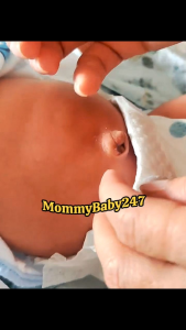 Que bạc nitrat - Que bạc nitrate 75% [Số lượng 15 que]