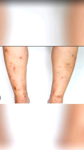 3 FOR 100 PEKLAT ERASE PEELING SOAP + NIACINAMIDE 100g