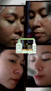 Nezzmg Skincare Reguler Acne