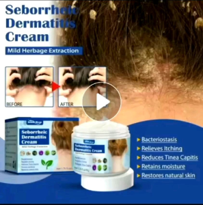 Krim Kulit Gatal Non-irritasi Anti-inflamasi Seborrheic Dermatitis Kepala Sehat Aman Efektif 50g