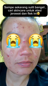 ORLIN BEAUTY/PAKET ACNE GLOWING/KRIM JERAWAT