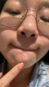 【COD】36Pcs/Set Acne Pimple Patch /Stiker Jerawat sticker jerawat / Penghilang & Stiker Jerawat / Komedo Untuk Perawatan Import Original-CH