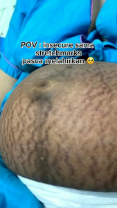 Stretchmark Cream Aleya Herbal Alami BPOM