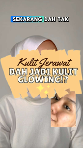 OME Acne Cream 5g Pimple Gel Acne Treatment Krim Jerawat Jeragat Foundation Blackhead Pore Spot