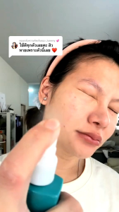 น้ำตบหยุดสิว  สิวหน้า สิวตัว จบที่BlAHMBOOH