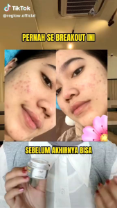 Reglow Paket Jerawat dan Beruntusan