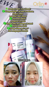 Skincare Orlin Beauty / Paket Acne Glow Membantu Merawat Kulit Wajah Sensitif Berjerawat / BPOM