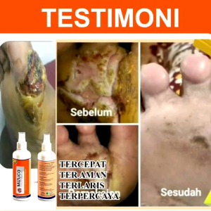 Obat Luka Diabetes Spray Terlaris\\n\\n Apa Itu Obat Luka Diabetes Spray?\\n\\nObat luka diabetes spray adalah solusi efektif dan mudah digunakan untuk mengatasi luka yang dialami oleh penderita diabetes. Dengan formula khusus yang dirancang untuk melindungi dan mempercepat penyembuhan luka pada kulit, obat luka diabetes spray menjadi pilihan tepat bagi mereka yang mencari pengobatan yang praktis dan efektif.\\n\\n Fungsi Utama Obat Luka Diabetes Spray\\n\\nFungsi utama obat luka diabetes spray adalah melindungi luka, mencegah infeksi, dan mempercepat proses penyembuhan luka pada kulit. Obat ini juga dirancang untuk mengurangi rasa sakit dan peradangan yang sering dialami oleh penderita diabetes.\\n\\n Manfaat Obat Luka Diabetes Spray bagi Penderita Diabetes\\n\\nObat luka diabetes spray memiliki berbagai manfaat bagi penderita diabetes, di antaranya:\\n\\n- Melindungi luka dari infeksi dan peradangan\\n- Mempercepat proses penyembuhan luka\\n- Mengurangi rasa sakit pada luka\\n- Mudah digunakan dan praktis\\n\\n Mengapa Harus Memilih Obat Luka Diabetes Spray?\\n\\nAda beberapa alasan mengapa Anda harus memilih obat luka diabetes spray sebagai solusi pengobatan luka diabetes:\\n\\n Efektivitas Obat Luka Diabetes Spray\\n\\nObat luka diabetes spray telah terbukti efektif dalam melindungi luka dari infeksi dan peradangan, serta mempercepat proses penyembuhan luka pada kulit. Hal ini membuat obat ini menjadi pilihan tepat bagi penderita diabetes yang mencari pengobatan yang efektif.\\n\\n Kenyamanan Penggunaan Obat Luka Diabetes Spray\\n\\nObat luka diabetes spray sangat mudah digunakan dan praktis. Anda hanya perlu menyemprotkan obat pada luka sesuai dengan instruksi yang diberikan, tanpa perlu repot-repot mengoleskan obat atau membalut luka. Hal ini membuat pengobatan menjadi lebih nyaman dan mudah.\\n\\n Cara Menggunakan Obat Luka Diabetes Spray dengan Tepat\\n\\nBerikut adalah langkah-langkah penggunaan obat luka diabetes spray yang tepat:\\n\\n1. Bersihkan luka dengan air bersih dan sabun.\n2. Lap luka dengan handuk bersih.\n3. Semprotkan obat luka diabetes spray pada luka sesuai dengan instruksi yang diberikan.\n4. Ulangi prosedur ini sebanyak 2-3 kali sehari, atau sesuai dengan anjuran dokter.