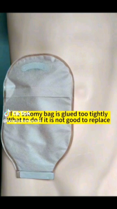 50ML Colostomy Adhesive Stoma Wipe-off Spray Ostomy Medical Adhesive Remover