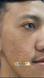 Dr FAY Cream Penghilang bopeng / Pudarkan Flek Hitam Dan Bekas Jerawat