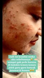 Paket Acne Glowing Orlin Beauty: Solusi Jerawat Meradang, Jerawat Batu & Beruntusan