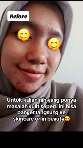Paket Skincare Acne Orlin Beauty: Pembersihan Jerawat Bulanan & Penyembuhan Jerawat Bruntusan