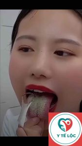 Cạo lưỡi Dụng cụ vệ sinh lưỡi inox  kèm hộp - Giúp loại bỏ vi khuẩn giảm hôi miệng tăng vị giác