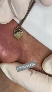 Thìa lấy mụn spa-Thìa cạo mụn