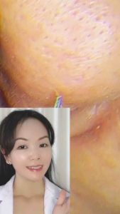Bộ dụng cụ nặn kẹp mụn đầu đentrứng cácó hộp đựng tiện lợihợp vệ sinh