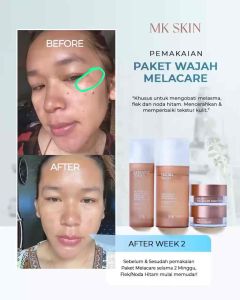 MK SKIN-MELACARE SERIES Membantu mengatasi Flek Hitam & Melasma