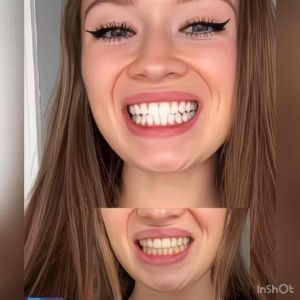 Oralhoe Advanced Technology Teeth Whitening Kit