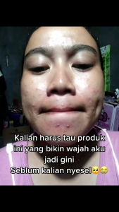 Paket Skincare Acne Hemat Orlin Beauty: BPOM Skincare Wajah