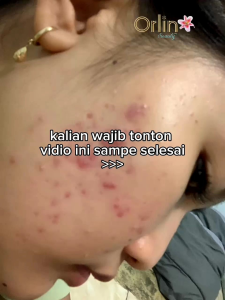 facial wash Acne Orlin beauty