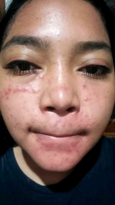 Paket Acne Whitening Platinum Can Beauty Canbeauty Package