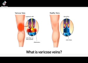 ORIGINAL obat herbal penghilang varises vaskulitis parises varikokel otot urat menonjol tanpa operasi varicose veins treatment