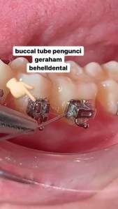 1Set isi 4pcs BUCCAL TUBE FDA ROTH M1 M2 Pengunci Behel Untuk Gigi Geraham - Buccaltube Second First Molar Band Bracket Dental Ortho Kunci Behel - Behelldental