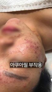 Tế bào gốc xử lý mụn Medula AC thế hệ mới Ampoule.