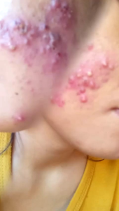 Facial Wash Acne Orlin Beauty Mencerahkan Mengontrol Minyak Mengurangi Peradangan Jerawat Melembabkan Kulit 60 Ml BPOM