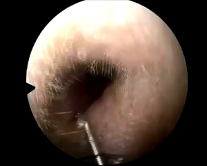 1 cây móc lác lấy ráy cứng dày lấy dị vật trong tai ngành ráy tai chuyên nghiệp 👂👂👂