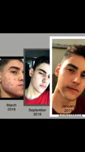 TIDACT GEL ORIGINAL FARMACY 1% ACNE TREATMENT