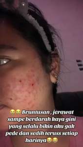 paket acne glowing/krim dokter/krim jerawat