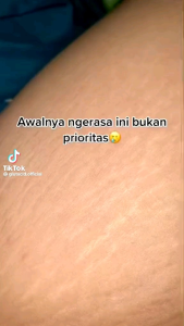 VITA SOFT OIL / MEMBANTU MENGHILANGKAN BEKAS LUKA CACAR JERAWAT DAN STRECHMARK. .