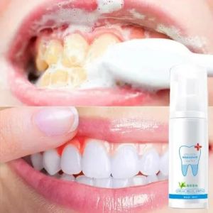 Cara Menggunakan Mousse Pemutihan Gigi & Alat Putih Gigi