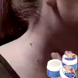 Warts Removal Cream ubat buang tahi lalat skin tag mole removal ubat hilangkan tahi lalat biji kolestrol remover