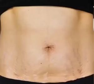 strechmark cream pregnancy cream krim stretchmark stretch mark pascamelahirkan penghilang strechmark 60g menghilangkan stretchmark saat hamil