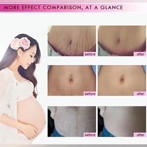 JEPAN Remove Stretch Mark Cream Pregnant Cream (Halal) Postpartum scar Remove Obesity Tattoo Care Firming Body Cream Stretch Marks Treatment