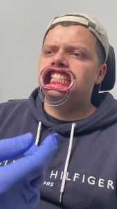 V34 TOOTHPASTE HISMILE Toothpaste for sensitive teeth Gum recovery SMILE EASE Whitening toothpaste 30ml