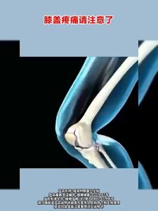 Miếng dán huyệt đầu gối. Giảm đau khớp cứng khớp và tê hiệu quả. Nhắm mục tiêu vào việc sửa chữa viêm bao hoạt dịch và chấn thương sụn chêm.1