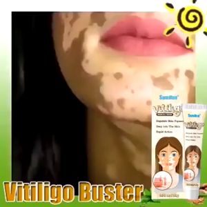 Krim vitiligo Vitiligo cream Menghilangkan vitiligo pada wajah dan kulit Menghambat pertumbuhan berbagai vitiligo Meratakan warna kulit Ekstrak tumbuhan alami
