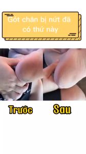 Máy Cạo Gót Chân Doco Tặng kèm kem dưỡng 2 chế độ mài đa dạng Pin sạc dùng 1 tháng Máy cạo gót chân Xiaomi Bảo hành 24 tháng