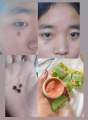 မှဲ့ဖျက်ဆေး. 