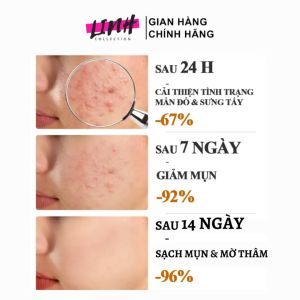[Cam Kết Hết Mụn Thâm Trong 7 Ngày] Kem Giảm Mụn Cấp Tốc Loại Bỏ Mụn và Vết Thâm Hoàn Toàn Thu Nhỏ Lỗ Chân Lông CYSTIC Acne Giúp Da Láng Mịn Khít Lỗ Chân Lông Kiểm Soát Dầu