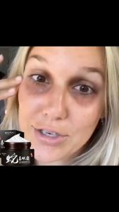 Penghilang Bengkak Mata & Krim Kantung Mata: Efektif Mengatasi Masalah Mata