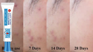 Donnail skin brightening herbal acne cream Redness Pimple Acne Scar repair acne pit acne 亮肤草本祛痘霜 祛红肿痘痘疤痕修复痘坑痘印 祛痘膏