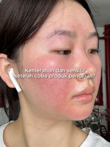FOCALSKIN 6X Brightening Serum 30ml Anti Jerawat & Menyamarkan Noda Hitam [Vitamin C + Niacinamide + Arbutin]