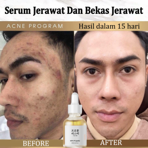 Serum Jerawat Propolis & Niacinamide: Solusi Jerawat & Pori-Pori Wajah