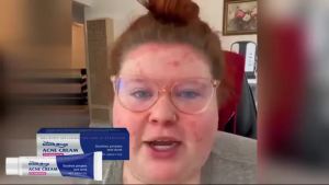 South Moon | Salicylic Acid Acne Cream Clean Pores Reduce Pimple Fade Acne Repair Damaged Skin Soothe Redness Aloes Extract Repair Acne Cream
