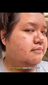 Lume Acne Spot Treatment Gel Totol Jerawat BPOM Skincare