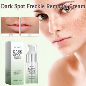 Freckle Removal Cream Whitening Acne Dark Spot Melanin Pigmentation Moisturizing Quick-acting Mole Skin Care